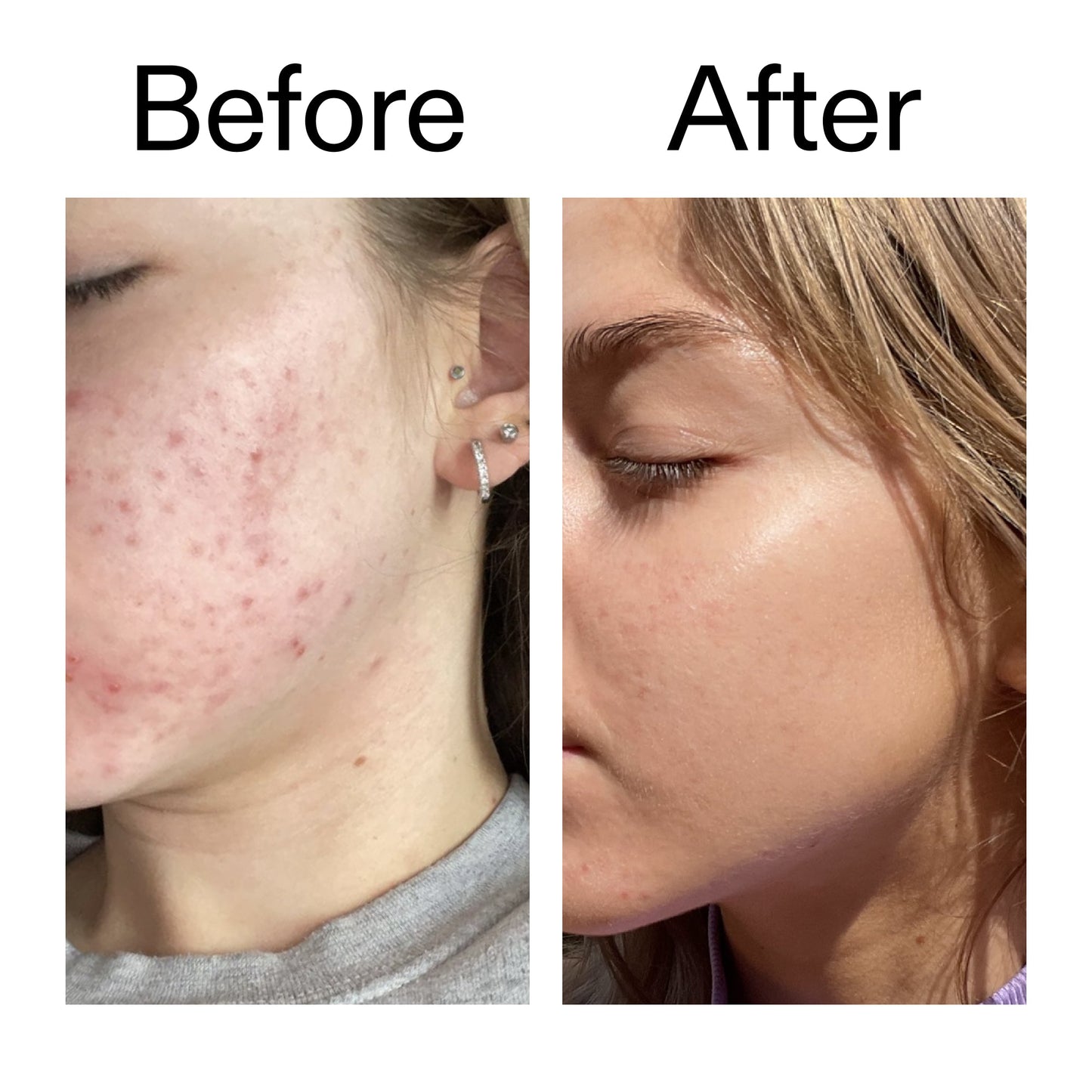 beta-hydroxy-acid-bha-serum-w1 Beta_Hydroxy_Acid_Serum_Before_After_2000x2000_96fda3e5-938d-49ef-bcf2-a0fa6ece4e2c.jpg