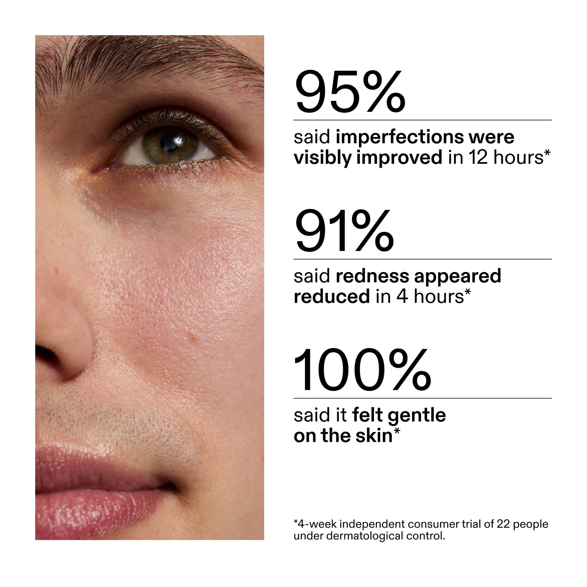 succinic-acid-acne-treatment-o4 CA_Succinic_Acid_Treatment_key_Claims_2000x2000_db91b0f1-7f29-4bfe-bb16-63a47f500960.jpg