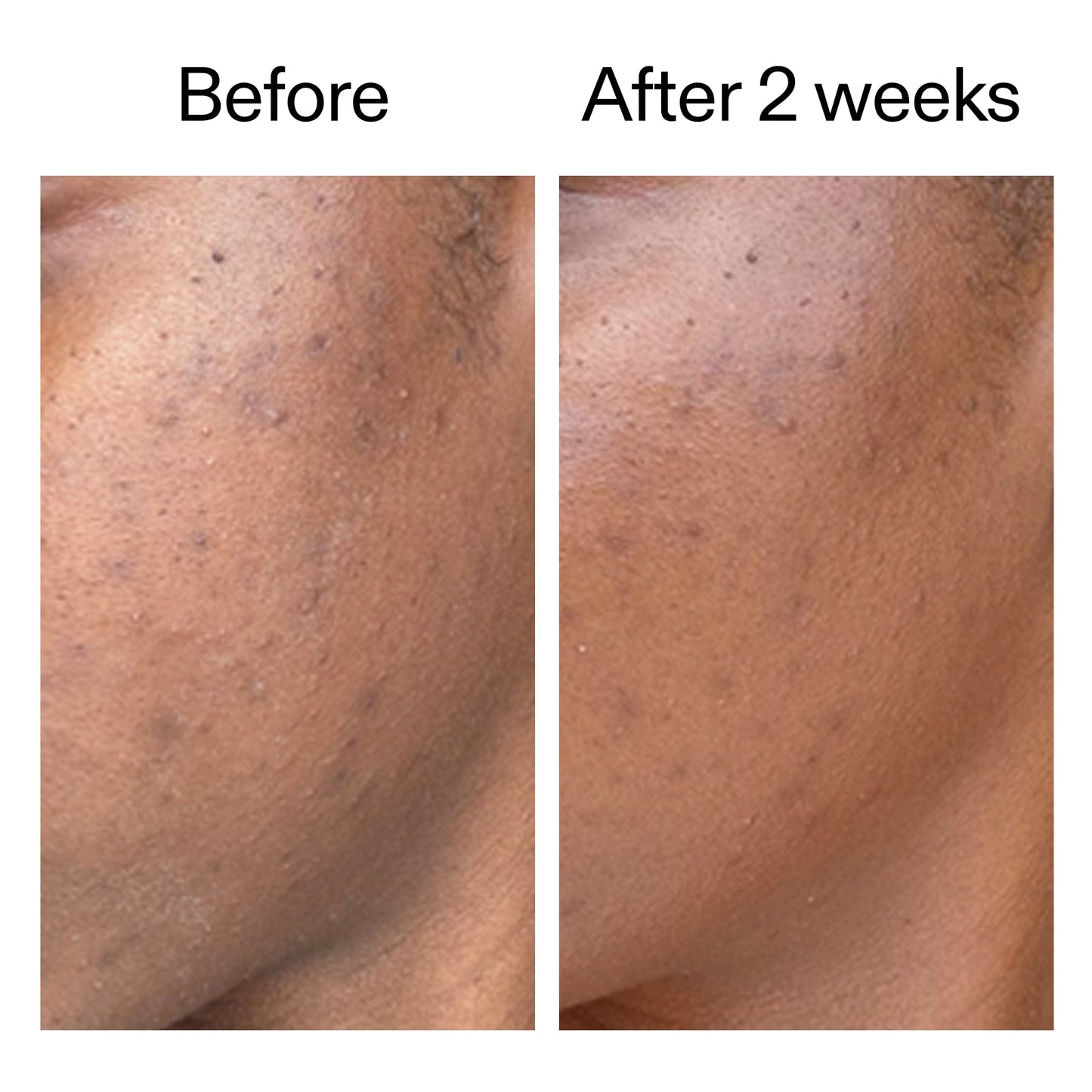 360-acne-clearing-serum-y7 DIOICB_A2000x2000.jpg