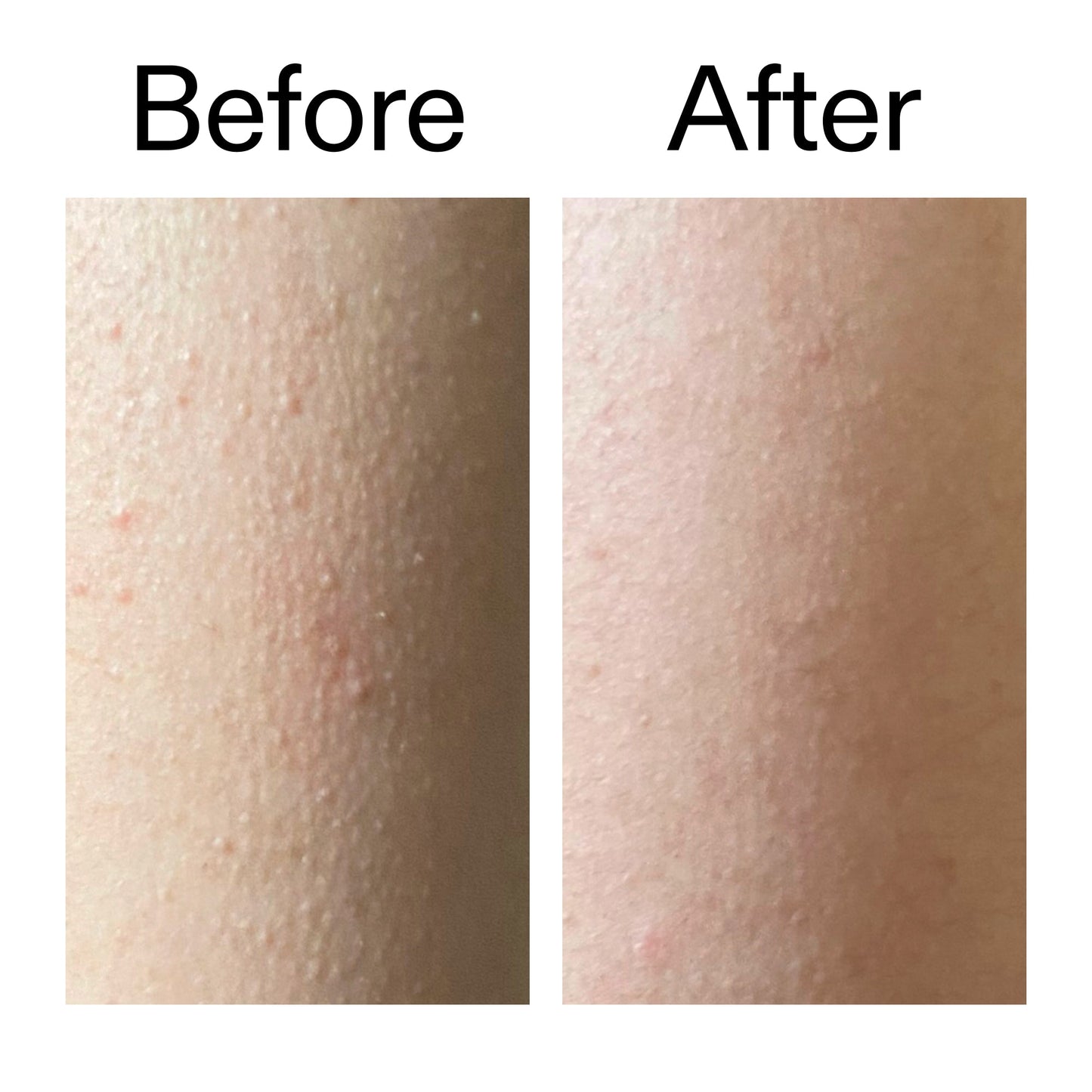 glycolic-acid-exfoliating-body-stick-duo-t7 Glycolic_Acid_Exfoliating_Body_Stick_Before_After_V2_2000x2000_2e4ba052-94f6-4d56-82df-7bdb5b2df7ae.jpg
