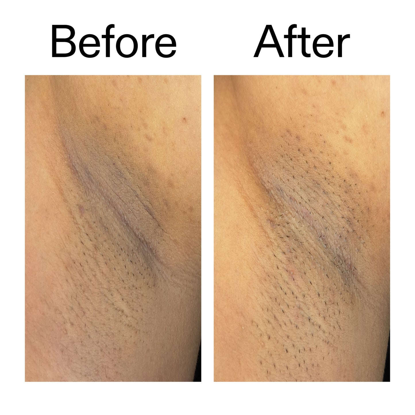 glycolic-acid-exfoliating-body-stick-duo-t7 Glycolic_Acid_Exfoliating_Body_Stick_Before_After_V3_2000x2000_ea919cd9-1439-4a46-82a0-76200eb5bb42.jpg