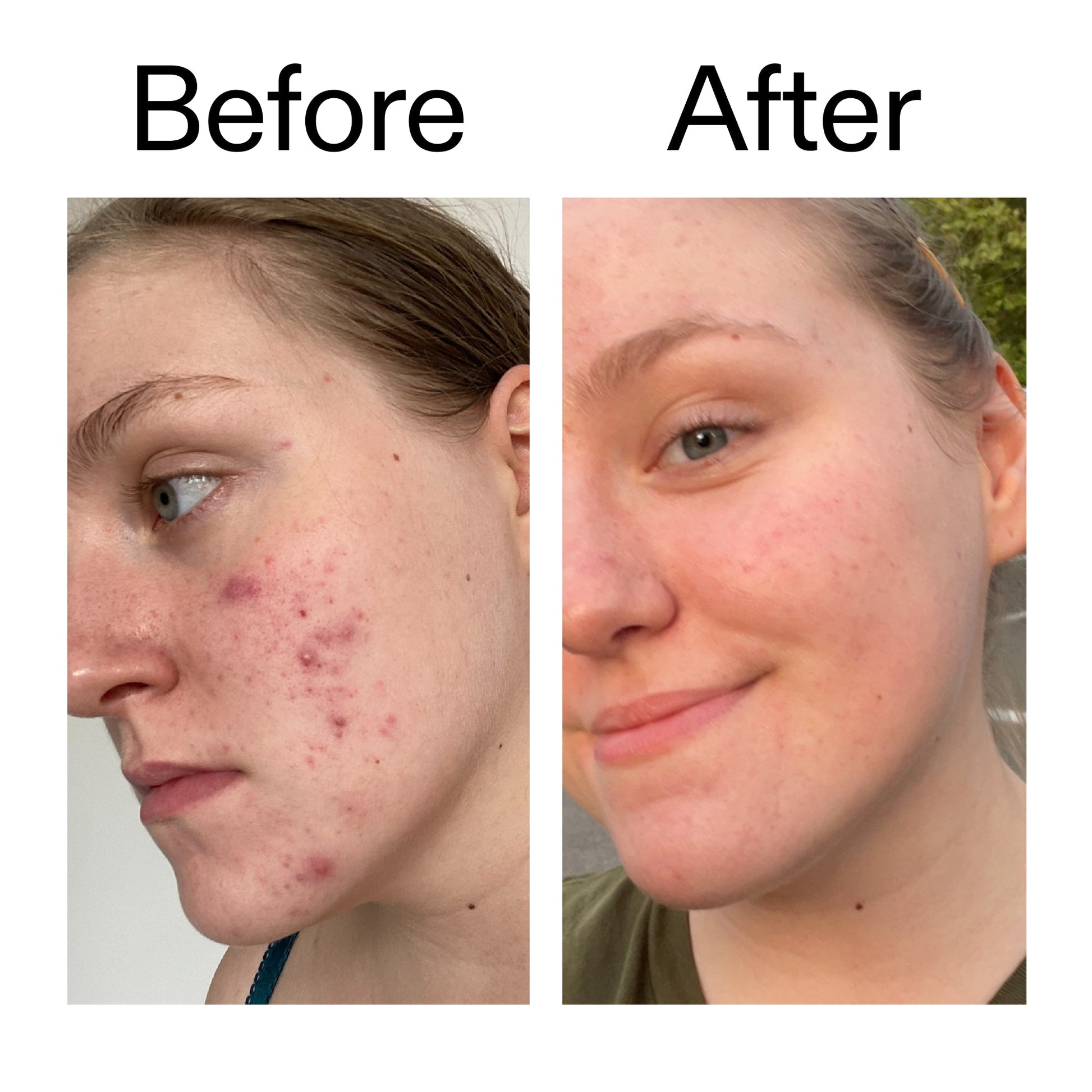 glycolic-acid-toner-i8 Glycolic_Acid_Toner_Before_After_2000x2000_49f0b9f7-e71b-4b2e-a8f8-2ea4b73247bb.jpg