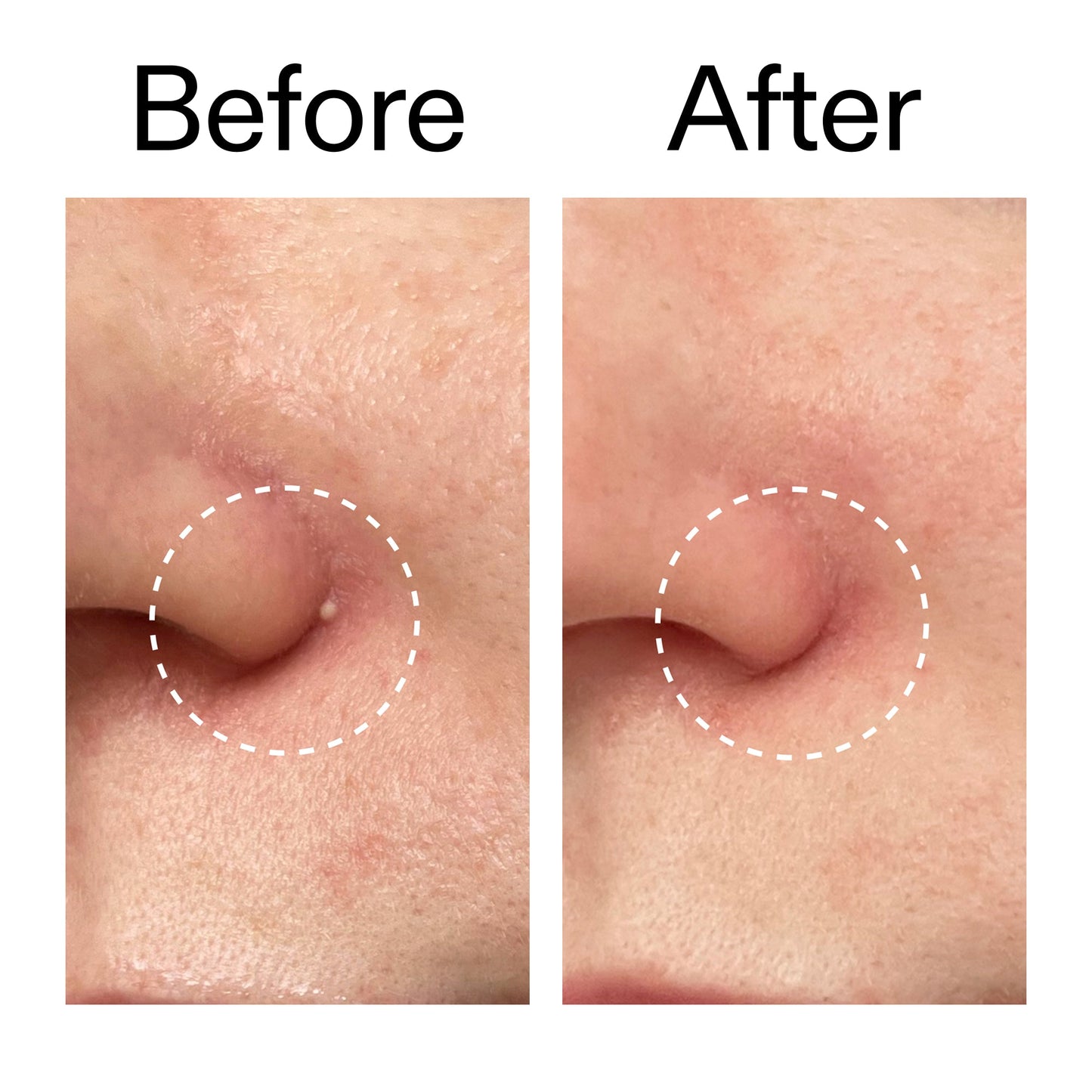 hydrocolloid-invisible-pimple-patches-pack-of-22-w7 Hydrocolloid_Invisible_Pimple_Patches_Before_After_2000x2000_b02aa37b-c78a-4682-91de-9135af5bb7df.jpg