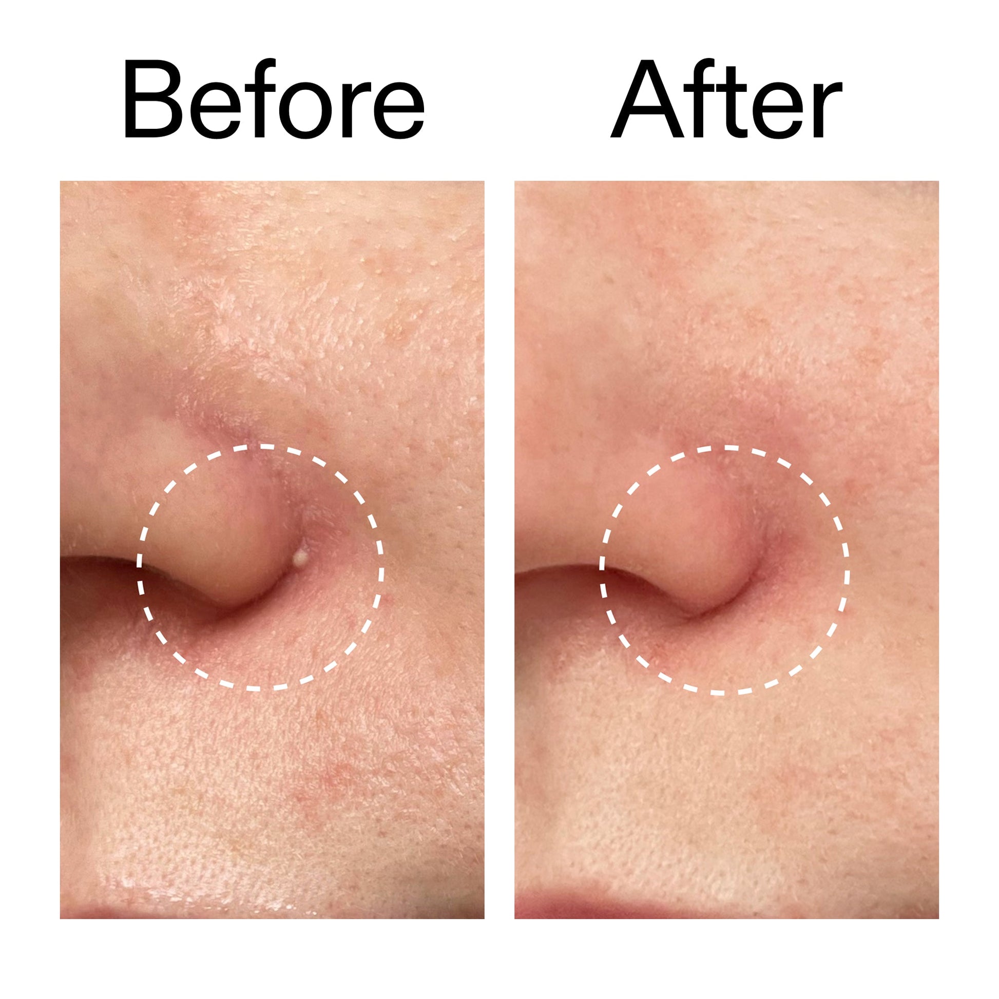 hydrocolloid-invisible-pimple-patches-pack-of-22-w7 Hydrocolloid_Invisible_Pimple_Patches_Before_After_2000x2000_b02aa37b-c78a-4682-91de-9135af5bb7df.jpg