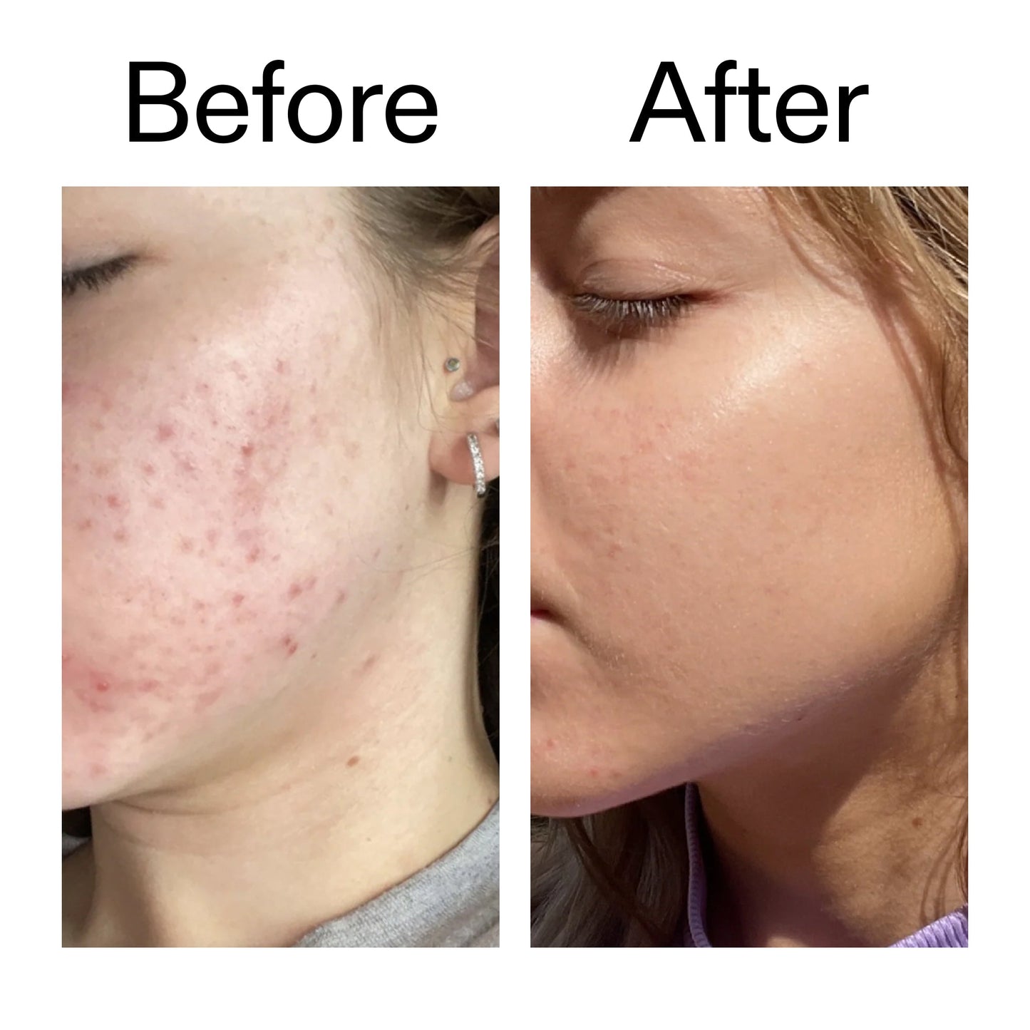 10-niacinamide-serum-x6 Niacinamide_Serum_Before_After_2000x2000_bde32455-9e7d-448e-b053-bef41504f0a9.jpg