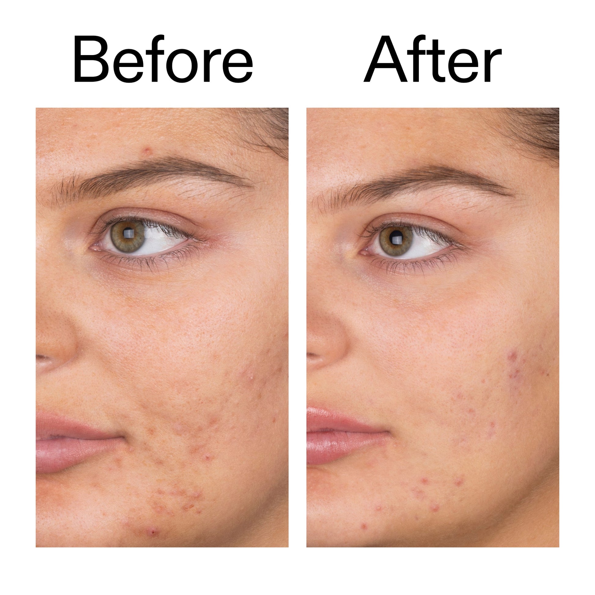 salicylic-acid-cleanser-duo-j2 Salicylic_Acid_Cleanser_-_150ml_Before_After_2000x2000_e7230494-853f-4b07-82b1-27669104c995.jpg
