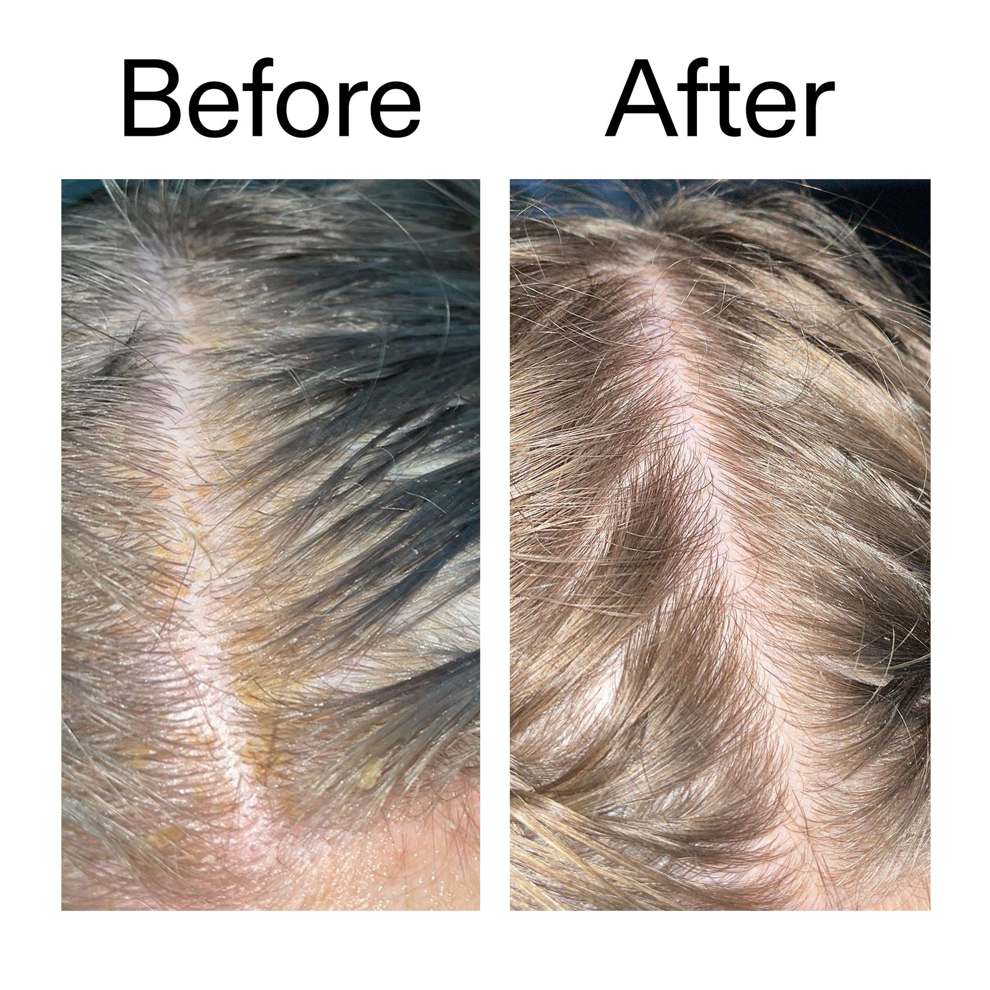 salicylic-acid-exfoliating-scalp-treatment-u7 Salicylic_Acid_Exfoliating_Scalp_Treatment_Before_After_2000x2000_e572a30f-057c-4a48-823b-1c09dc97f8d0.jpg