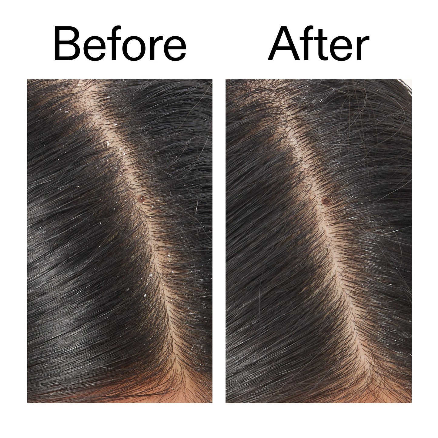 salicylic-acid-exfoliating-scalp-treatment-u7 Salicylic_Acid_Exfoliating_Scalp_Treatment_Before_After_V2_2000x2000_02bd61ad-42bf-490b-b3e3-7e04b2e8a673.jpg