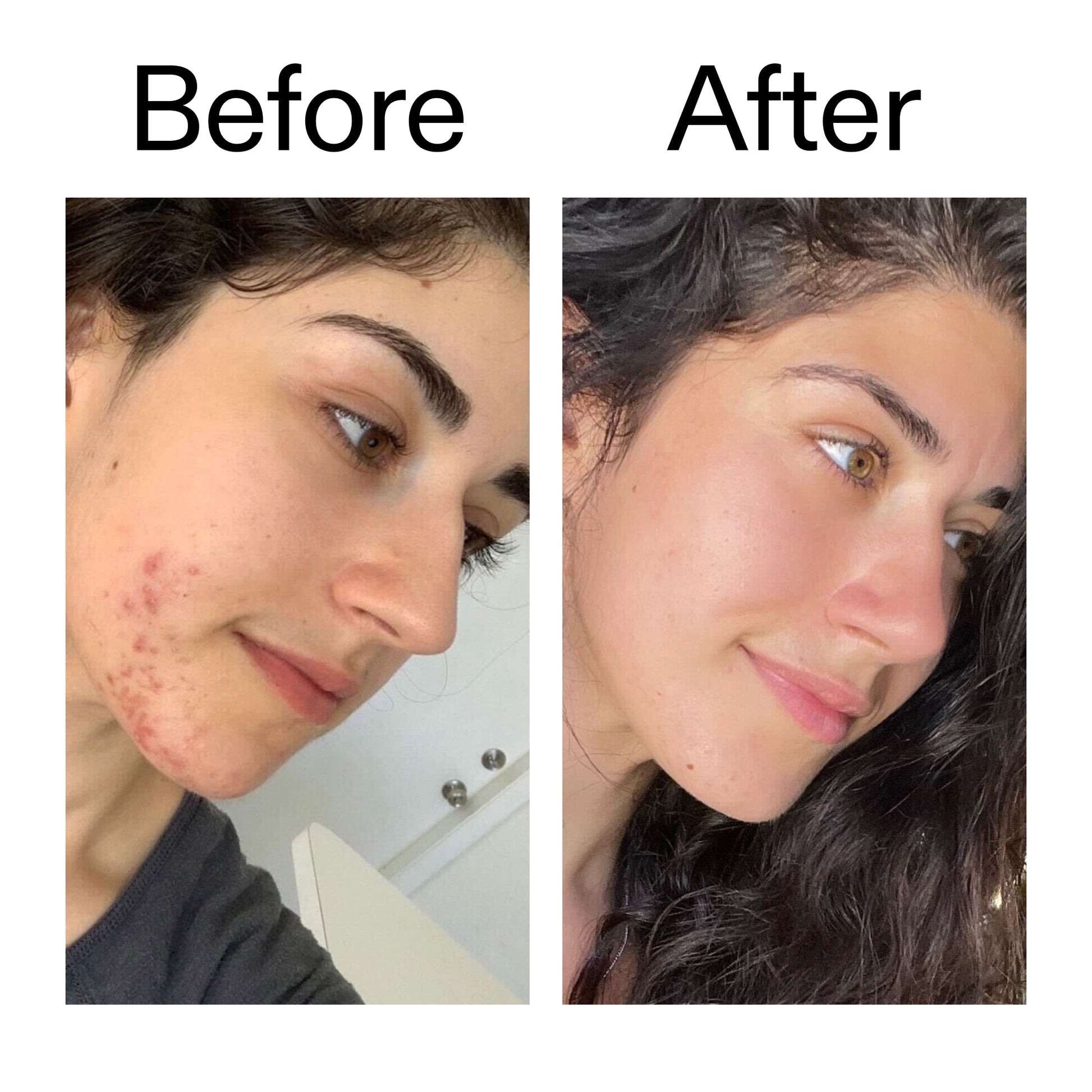 succinic-acid-acne-treatment-o4 Succinic_Acid_Treatment_Before_After_2000x2000_6a5f0054-2f58-4433-9314-0dc72c9bdd3b.jpg
